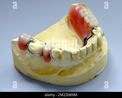 Prothèse dentaire | Prothèse dentaire imprimante en plateau et prothèse 13/03/2018 Banque D'Images