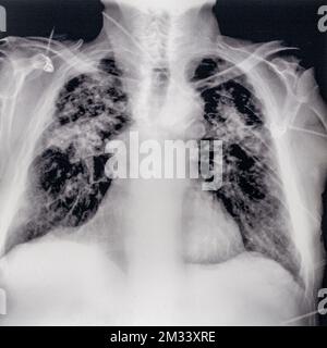 Ancienne photographie / radiographie du milieu du 20th siècle montrant le poumon du mineur / silicose, maladie pulmonaire causée par l'inhalation de poussière de silice cristalline Banque D'Images