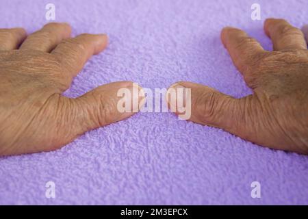 Deux mains froissées avec de l'arthrite sur un fond violet. maladie chez les personnes âgées. Banque D'Images
