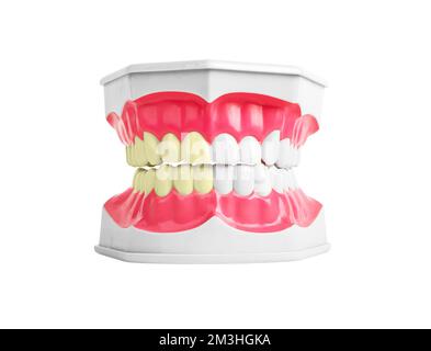 Mâchoire dentaire avant et après le blanchiment concept. Santé vs malsain, mauvais versus bonnes dents. Émail blanc et jaune. Photo de haute qualité Banque D'Images