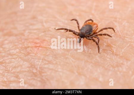 Le haricot de ricin parasite tick à mordu sur une peau humaine. Ixodes ricinus. Gros plan du parasite de l'insecte sur l'épiderme rose. Transmission de maladies transmises par les tiques. Banque D'Images