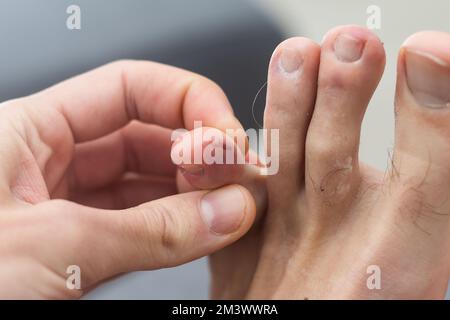 endommagé un gros ongle sur le pied mâle. Banque D'Images