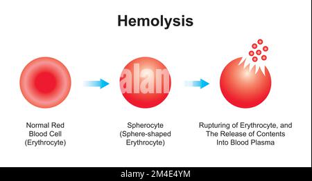 Conception scientifique de l'hémolyse. La destruction des globules rouges. Symboles colorés. Illustration vectorielle. Illustration de Vecteur