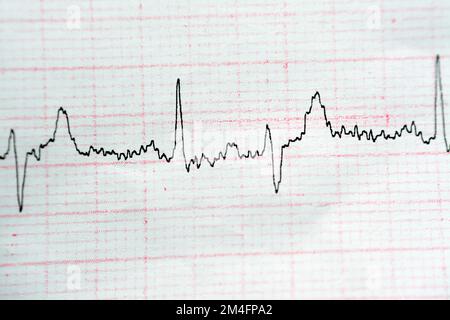 Papier d'électrocardiographe ECG présentant un NSR de rythme sinusal normal avec des contractions auriculaires prématurées PACS fréquentes, des ESV et des contracti ventriculaires prématurés Banque D'Images