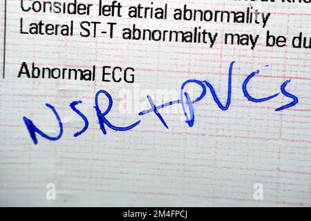 Papier d'électrocardiographe ECG présentant un NSR de rythme sinusal normal avec des contractions auriculaires prématurées PACS fréquentes, des ESV et des contracti ventriculaires prématurés Banque D'Images