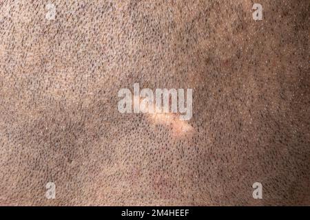 Macro d'une cicatrice sur le cuir chevelu d'un homme aux cheveux rasés. Concept de chirurgie et tissu cicatriciel. Opération sur la tête d'un homme adulte. Banque D'Images