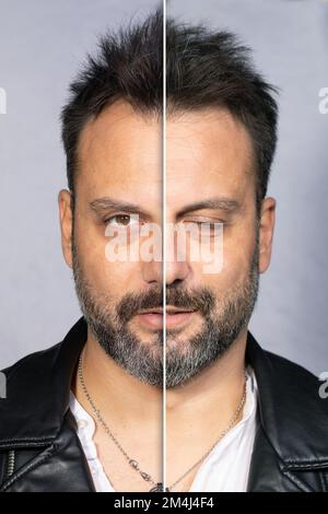 Effets avant et après la paralysie faciale. Paralysie de Bell causée par l'inflammation du nerf facial Banque D'Images