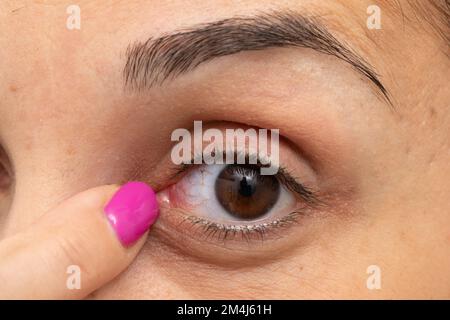 Macro de l'œil de la femme avec des capillaires rouges. Doigt indiquant une rougeur. Concept d'allergie et de conjonctivite Banque D'Images