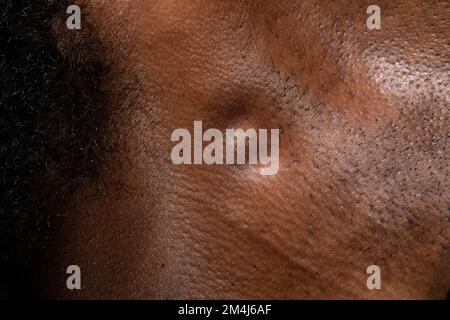 Macro des ganglions lymphatiques enflés dans le cou d'un homme africain, réponse immunitaire du système lymphatique ou possibilité de malignité Banque D'Images