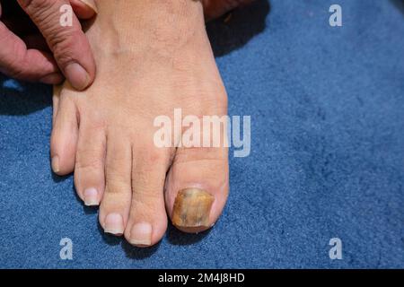 Une vue rapprochée sur le pied d'un homme avec un gros ongle jaune et épais, les symptômes de l'onychomycose, une infection fongique commune des ongles d'orteil. Banque D'Images