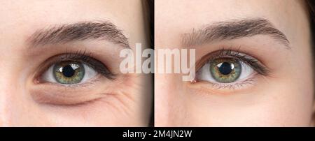 Femme yeux avant et après un traitement anti-âge pour les rides et les pieds de corbeau Banque D'Images