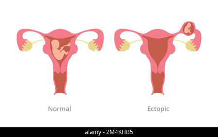 grossesse extra-utérine problème de grossesse avec comparaison avec la grossesse normale avec l'illustration moderne de vecteur de style plat Banque D'Images