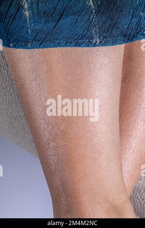 Les jambes de la femme s'écaillent en raison d'une peau excessivement sèche et déshydratée. Manque d'hydratation après être au soleil. Dommages causés par les rayons UV. Banque D'Images