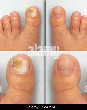 Avant et après le traitement réussi de la mycose sur le gros orteil d'une femme adulte, résultats d'un médicament pour traiter l'infection fongique de l'ongle du pied. Banque D'Images