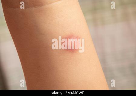 Éruption cutanée et allergie de bébé avec tache rouge cause par piqûre de moustique au bras. Photo de haute qualité Banque D'Images