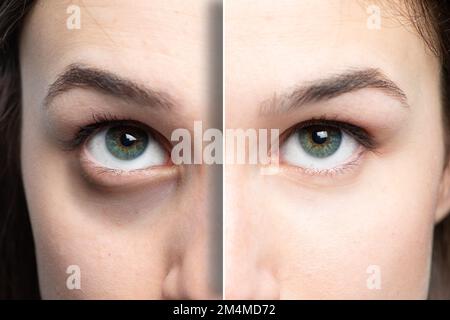 rides des yeux des femmes avant et après les traitements. Banque D'Images