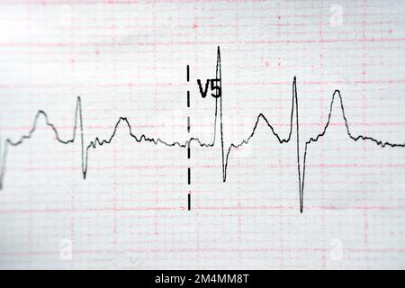 Papier d'électrocardiographe ECG présentant un NSR de rythme sinusal normal avec des contractions auriculaires prématurées PACS fréquentes, des ESV et des contracti ventriculaires prématurés Banque D'Images