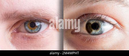 deux cas différents d'hétérochromie de l'œil de deux femmes. Macro de couleurs bleu et marron iris oculaire. Banque D'Images