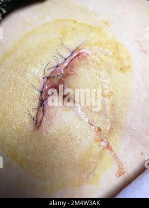 suture après la chirurgie, coutures filets vue du dessus sur la zone abdominale du corps humain, suture plaie après la chirurgie hernie sur umbilicus gros plan Banque D'Images