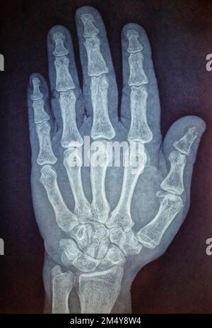 Radiographie de la main humaine, radiographie des os de la main, os infectés dans le pouce, vue de dessus Banque D'Images