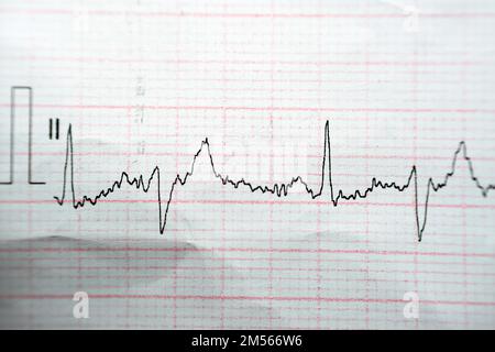 Papier d'électrocardiographe ECG présentant un NSR de rythme sinusal normal avec des contractions auriculaires prématurées PACS fréquentes, des ESV et des contracti ventriculaires prématurés Banque D'Images