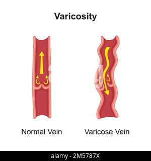 Conception scientifique de veine variqueuse. Symboles colorés. Illustration vectorielle. Illustration de Vecteur