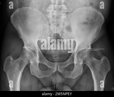 radiographie d'une hanche humaine, corps masculin dans le 50s Banque D'Images