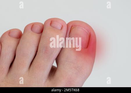 Inflammation du pied femelle avec tache rouge. Concept de la douleur et de la maladie des pieds Banque D'Images