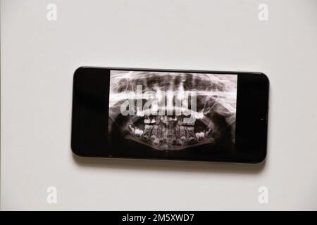 La prise de vue panoramique montre plusieurs dents incrustées et impactées sur la mâchoire supérieure et inférieure des dents des enfants sur les écrans du téléphone, application mobile Banque D'Images