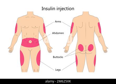 Vecteur graphique de l'injection d'insuline. Traitement du diabète et injection d'insuline sur le corps humain. Fesses, haut des bras extérieurs et endroits de l'abdomen. Illustration de Vecteur