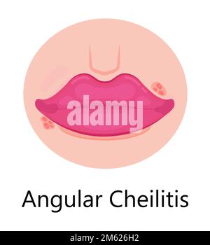 Vecteur de lèvres d'herpès. L'infection par le virus simplex provoque des épisodes récurrents de petites cloques douloureuses et remplies de liquide sur la peau, la bouche, les lèvres. Illustration de Vecteur