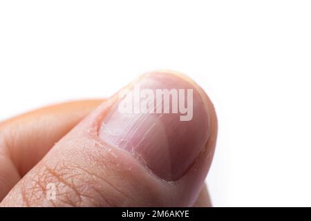 Ongle strié d'un pouce d'un homme avec des crêtes verticales sur fond blanc. Banque D'Images