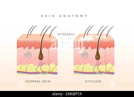 Anatomie de la peau et de la peau avec Vitiligo - stock Illustration comme fichier EPS 10 Illustration de Vecteur