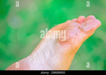 Sécher la peau déshydratée sur les talons des pieds femelles avec des callosités Banque D'Images