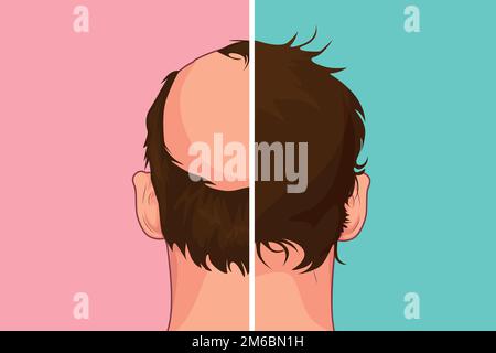 Perte de cheveux. Stades de l'alopécie homme problème vecteur santé médicale illustration avant après Illustration de Vecteur