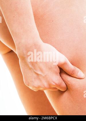 Woman la cellulite sur les jambes Banque D'Images