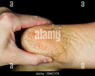 Peler la peau sur le talon Banque D'Images