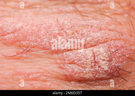 Psoriasis irritation sèche rouge et blanc sur la peau gros plan. Banque D'Images