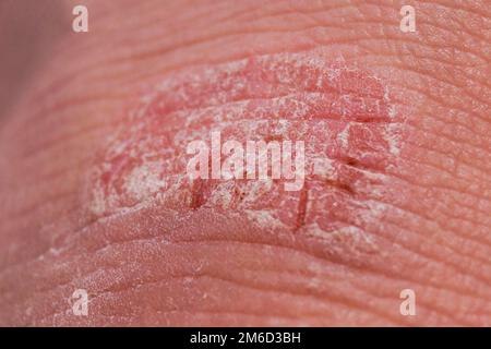 Psoriasis irritation sèche rouge et blanc sur la peau gros plan. Banque D'Images