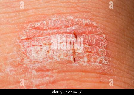 Psoriasis irritation sèche rouge et blanc sur la peau gros plan. Banque D'Images