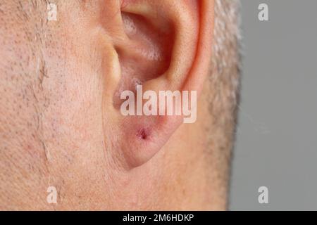 Macro d'un trou de perçage d'un homme dans son oreille, avec irritation d'une infection bactérienne causant le blocage. Le concept d'hygiène dans l'insertion des boucles d'oreilles proc Banque D'Images