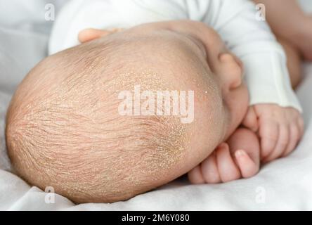 la dermatite séborrhéique crose sur la tête du bébé. enfant avec séborrhée dans les cheveux, problèmes de peau nouveau-nés Banque D'Images