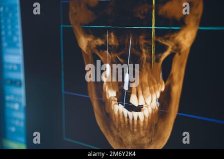 gros plan de l'interface logicielle de radiographie dentaire sur écran numérique en clinique dentaire Banque D'Images