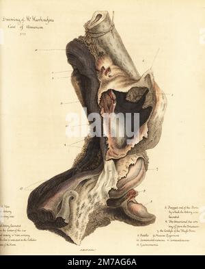 Sac anévrystique mortel de la jambe cassée d'un homme, 1815. Le marin est mort de gangrène avant que la jambe ne puisse être amputée. Dessin du cas d'anévrisme de M. Harkness. Veine fémorale 1, artère fémorale 2, artère fémorale lacérée 3, artère poplitée 4, extrémité déchiquetée de l'os 5, sac anévrystique 6, condyle de l'os de la cuisse 7, putella 8, ligament de la muqueuse 9, semimembranosus 10, semilendinosus 11, gastroenemii 12. Gravure de copperplate de couleur main par après une illustration de John Bell de ses propres principes de chirurgie, comme ils se rapportent aux blessures, aux ulcères et aux fistules, Longman, Hurst, Rees, Orme et Brown, Banque D'Images