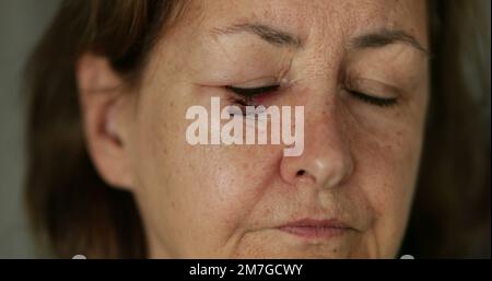 Femme plus âgée avec cicatrisation après chirurgie Banque D'Images