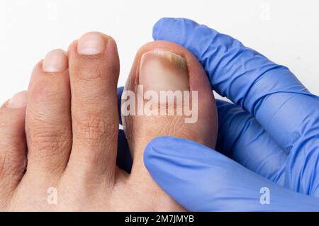 Image rapprochée du médecin qui contrôle l'orteil gauche qui souffre d'un clou champignon Banque D'Images