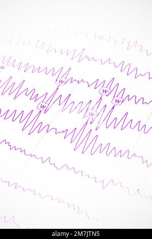 Résultats de l'électroencéphalogramme sur papier, diagnostic de l'épilepsie Banque D'Images