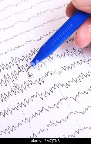 Résultats de l'électroencéphalogramme sur papier, diagnostic de l'épilepsie Banque D'Images