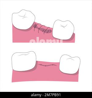 Illustration médicale du processus d'extraction des dents malsain. Cicatrisation de la plaie. Illustration de Vecteur