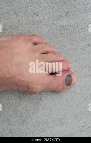 gros plan de l'ongle de l'orteil ecchymose hemtoma. orteil clou ecchymose hemtoma sur le pied. orteil clou ecchymose hemtoma. Banque D'Images